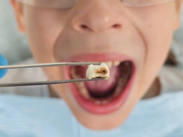 Best Knocked-Out Tooth (Avulsed Tooth) Treatment in Seven Oaks, SC